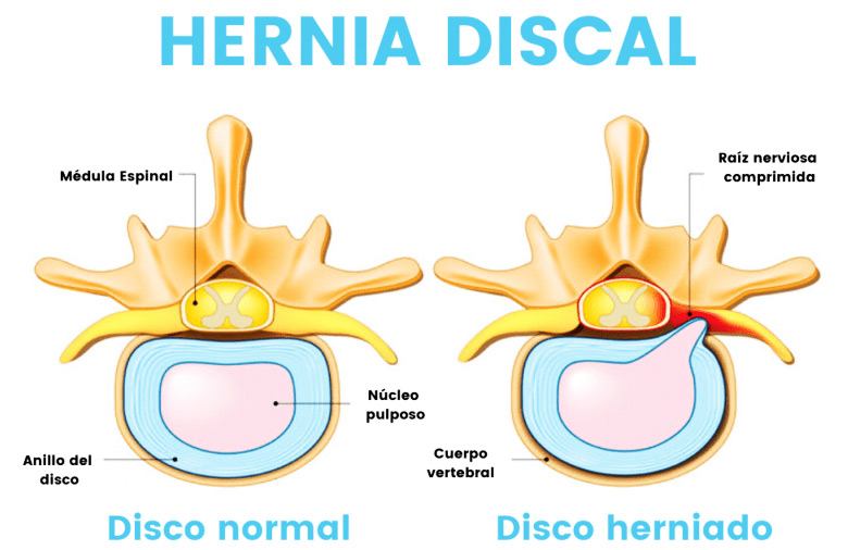 hernia--disco - copia.jpg