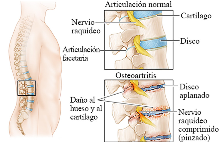 osteoartritis - copia.jpg